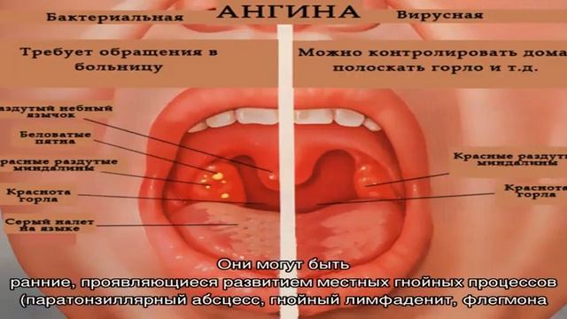 Виды ангины у детей