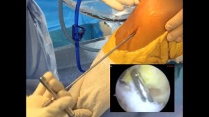 9 Пластика ПКС, техника ALL INSIDE