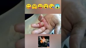 давим огромные прыщи. прыщи в горле. жесть!!!