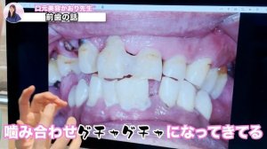 【危険】えらいこっちゃ　歯石ボコんとついとるやん　　お口放置プレーの危険性を唱える　歯医者かおり