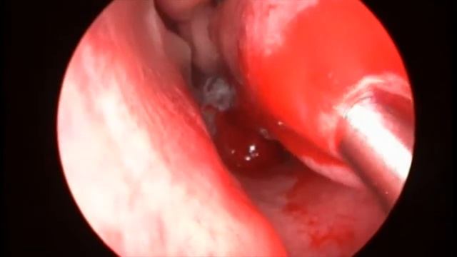 Шейверная подслизистая редукция нижних раковин (microdebrider-assisted turbinoplasty) смотреть онлайн