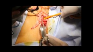 Реконструкция женской уретры