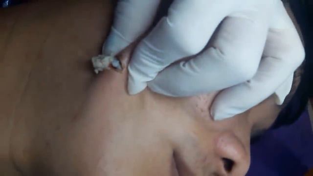 # 4 Большая черная точка\КАМЕДОН\Большой жировик\удаление черноголовых