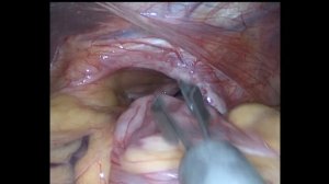 Ущемленная параэзофагеальная грыжа пищеводного отверстия диафрагмы