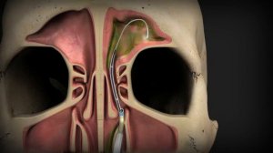 Выведение гноя из лобных пазух. Анимация баллонной синупластики