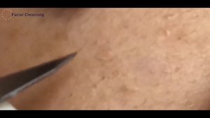 #7 Blackhead Removal \ Удаление черных точек