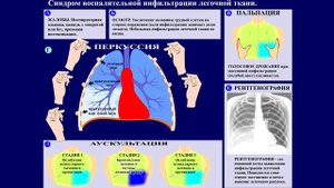 Тема 51.2. Синдром инфильтрации легочной ткани.