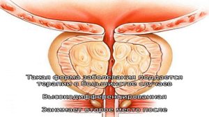 Особенности протекания аденокарциномы предстательной железы