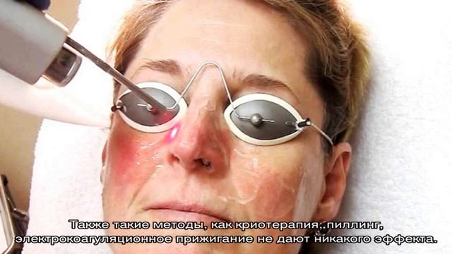 Лечение розацеи лазером