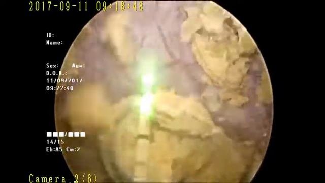 Трансуретральная лазерная цистолитотрипсия
