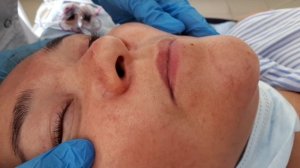 Невус на лице. Удаление методом лазерной деструкции