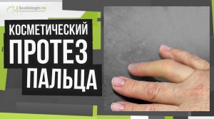 Индивидуальный косметический протез пальца