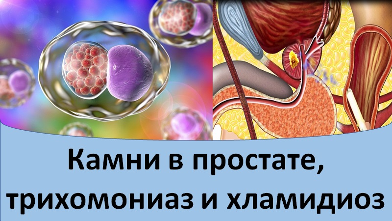 Камни в простате. Трихомониаз и хламидиоз.