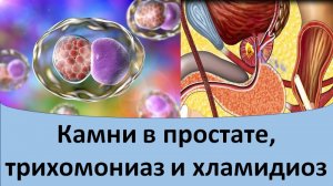 Камни в простате. Трихомониаз и хламидиоз.