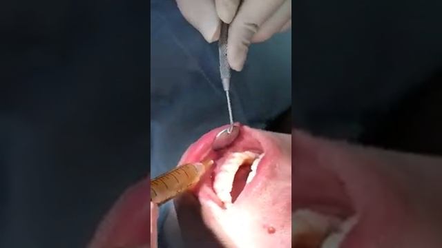 Plasmolifting