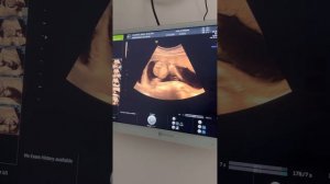 узи 20 недель ultrasound Diana