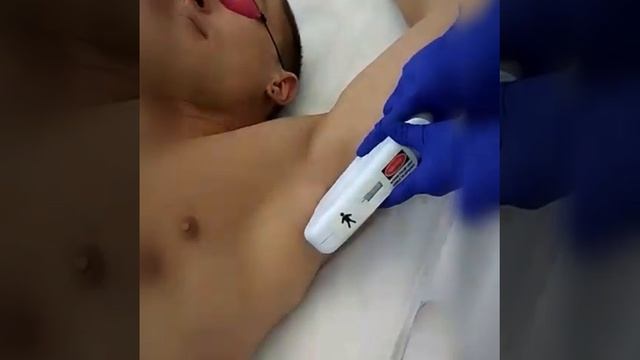 Лазерная эпиляция подмышечных впадин смотреть онлайн