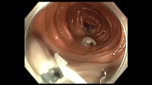 ПАРАЗИТЫ ЖИВУТ ВНУТРИ НАС Colonoscopy - Colon Polyp with Cancer