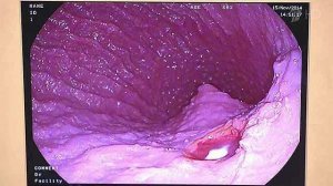 Как правильно пройти обследование. Гастроскопия. Жить здорово! Фрагмент выпуска от 05.02.2015