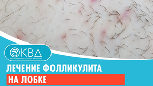 ✅ Лечение фолликулита на лобке. Клинический случай №1033