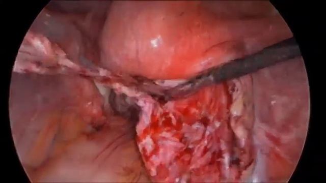 Эндометриоидная киста яичника хирургическое лечение