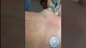 Липофилинг груди - коррекция формы и объёма груди собственным жиром.