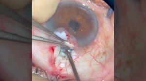 TEC (trabeculectomy) ТЭК (трабекулэктомия)