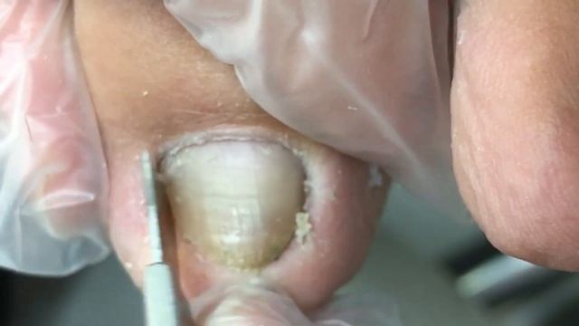 There is black dirt deep inside the ingrown toenail!【Crazy pedicure room】 смотреть онлайн