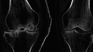 Компьютерная томография коленного сустава. Разбор случая.