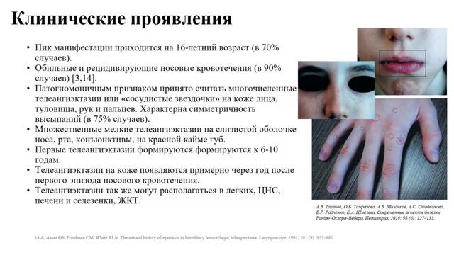 Редкий вариант первичной цилиарной дискинезии в сочетании с наследственной геморрагической телеанги