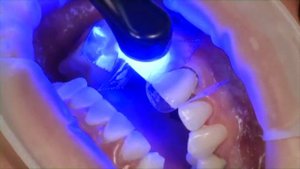 Установка композитных виниров