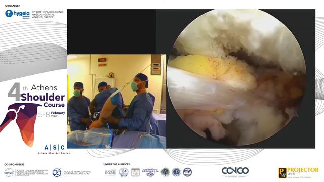 #ASC2020 Massive rotator cuff tears: Partial repair + inspace balloon implantation смотреть онлайн