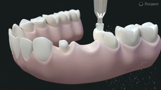 Мост на 3 коронки смотреть онлайн