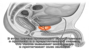 Кальцификаты в неоднородной эхоструктуре предстательной железы: что это?
