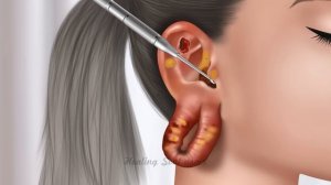 ASMR Remove unmanaged piercing pus animation | Squeeze nose acne