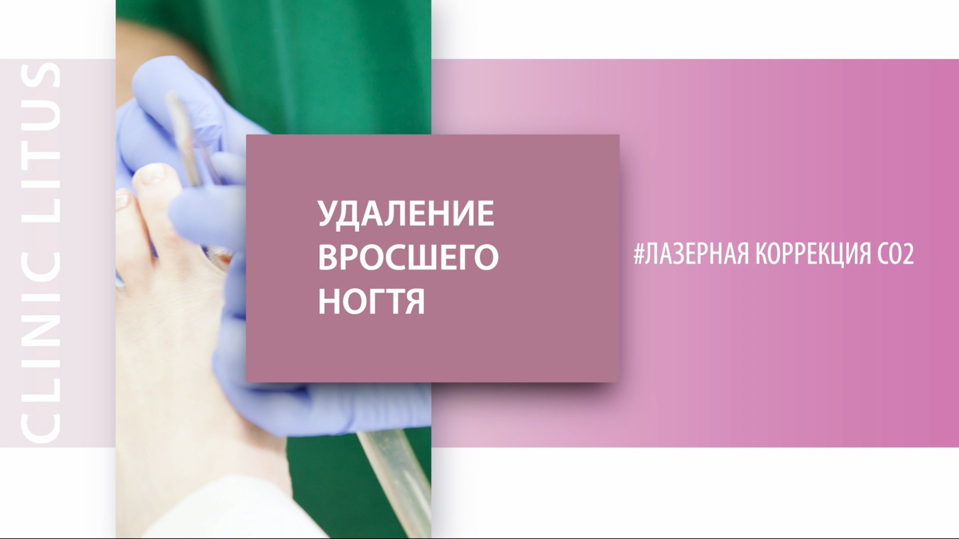 Вросший ноготь. Лазерное удаление вросшего ногтя. Лазерная коррекция вросшего ногтя. Удалить лазером