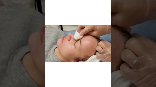 Обновление кожи. Удаление морщин. ТСА жесткий пилинг заменяет фотоомоложение.