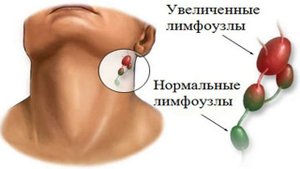 ВИРУС ЭПШТЕЙН БАРР