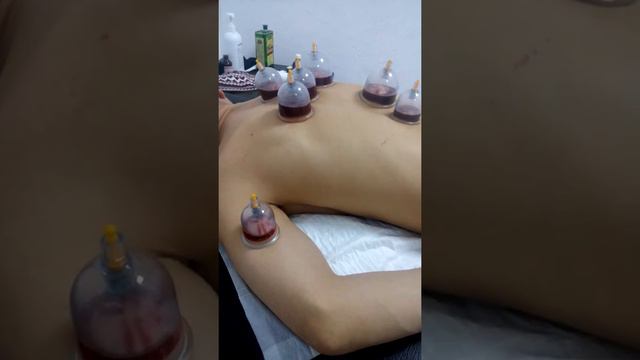 Кровопускание ( Хиджама )