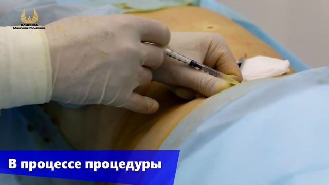 Липосакция."Брителечный" жир и бока смотреть онлайн