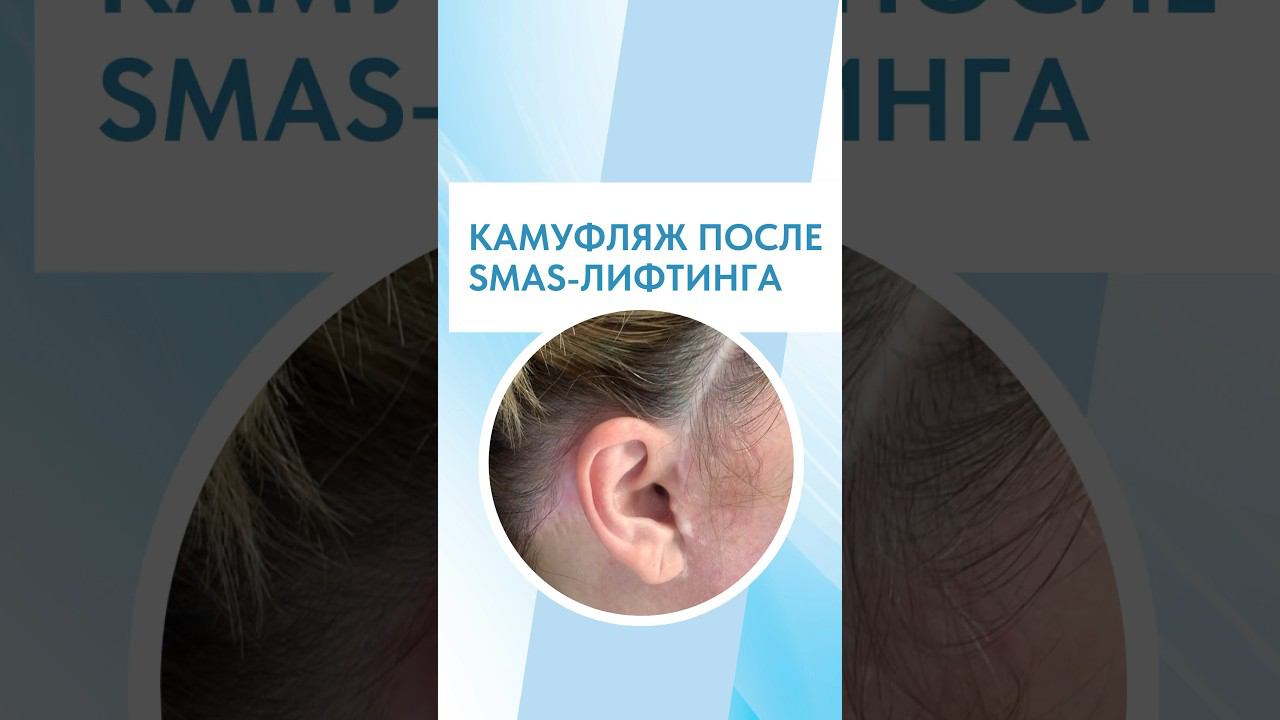 КАМУФЛЯЖ ПОСЛЕ SMAS-ЛИФТИНГА
