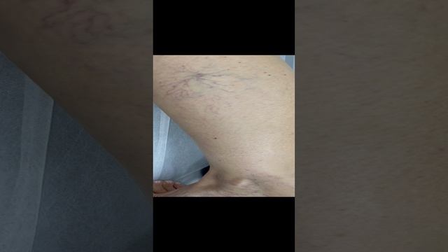 Сосудистая сетка на ногах. Варикоза нет. Склеротерапия. Флеболог Москва. Флеболог. Лечение вен смотреть онлайн