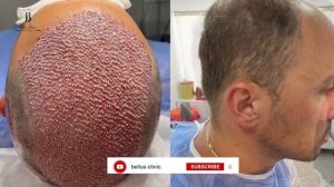 hair transplant in Bellus clinic