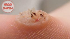 Почему у людей появляются бородавки?