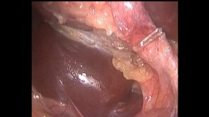 Laparoscopic cholecystectomy приключения брутальных хирургов 48