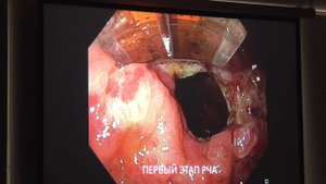 62 Бордиков МВ Радиочастотная аблация РЧА при GAVE синдроме