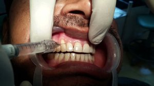 Реконструкция межзубного сосочка с использованием гиалуроновой кислоты