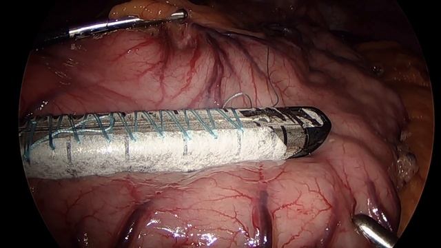 Laparoscopic Sleeve Gastrectomy: Surgical Technique смотреть онлайн