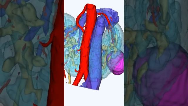 Подковообразная почка и опухоль. Искусственный интеллект и 3D-моделирование