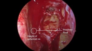 Full Functional Endoscopic Sinus Surgery (FESS) for sinusitis